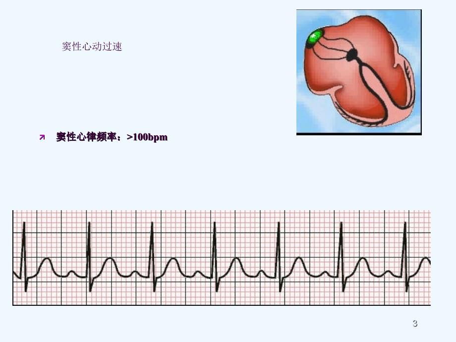 急救培训心电图ppt课件_第3页
