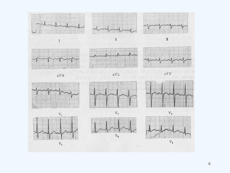 急救培训心电图ppt课件_第4页