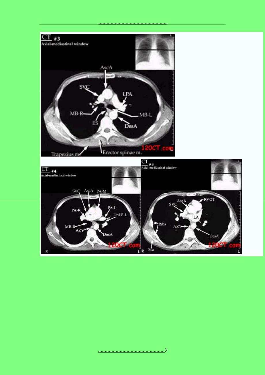 CT断层解剖图(胸部-心脏)_第3页