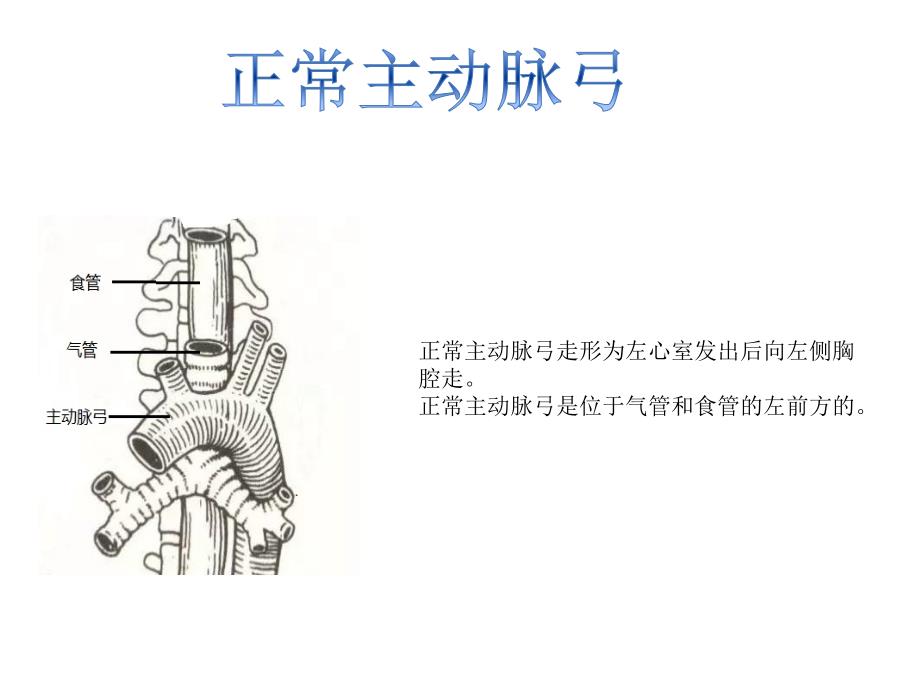 右位主动脉弓.ppt_第2页