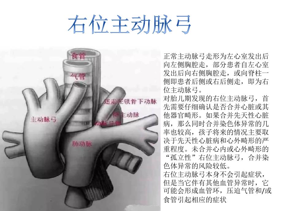 右位主动脉弓.ppt_第3页