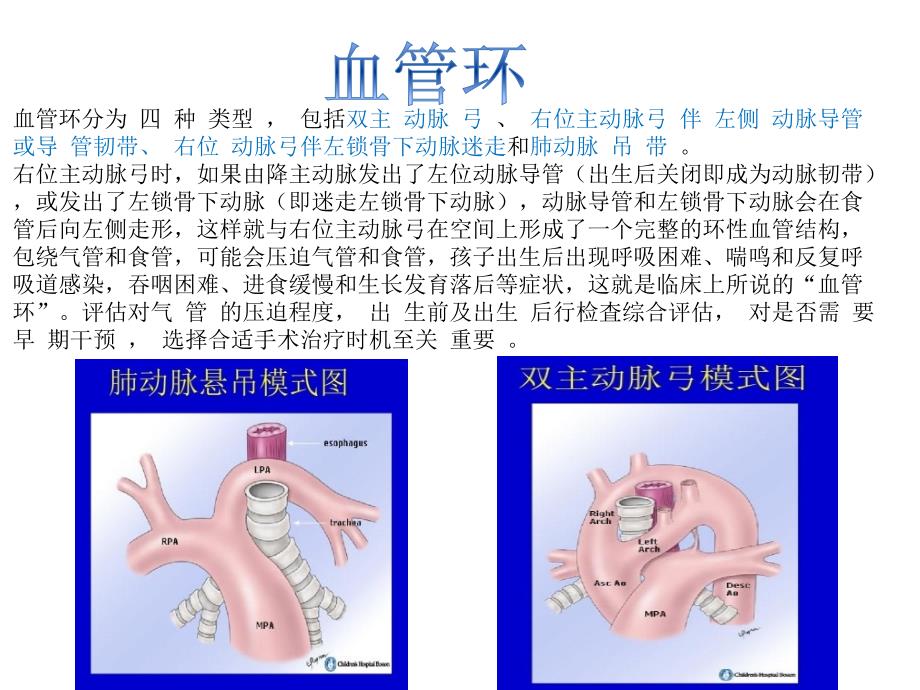 右位主动脉弓.ppt_第4页