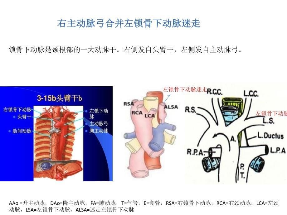 右位主动脉弓.ppt_第5页