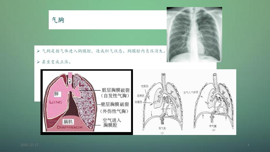 胸腔穿刺术实用讲解_第4页