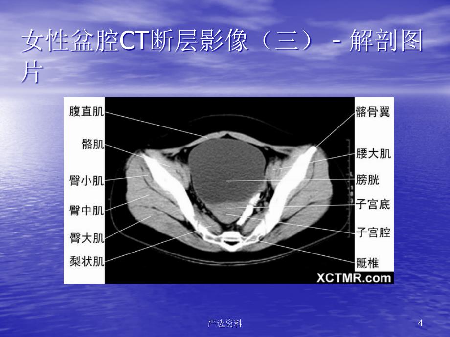 盆腔CT诊断（行业荟萃）_第4页