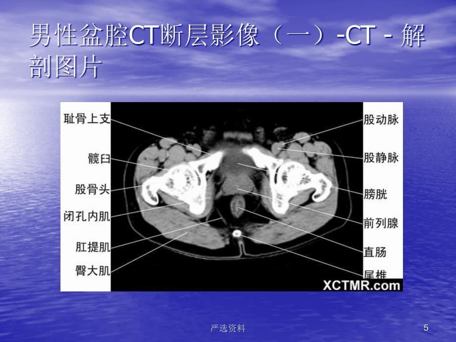 盆腔CT诊断（行业荟萃）_第5页