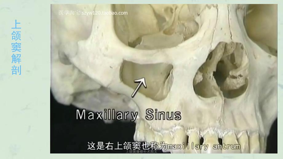 上颌窦瘘修补术图文课件_第4页