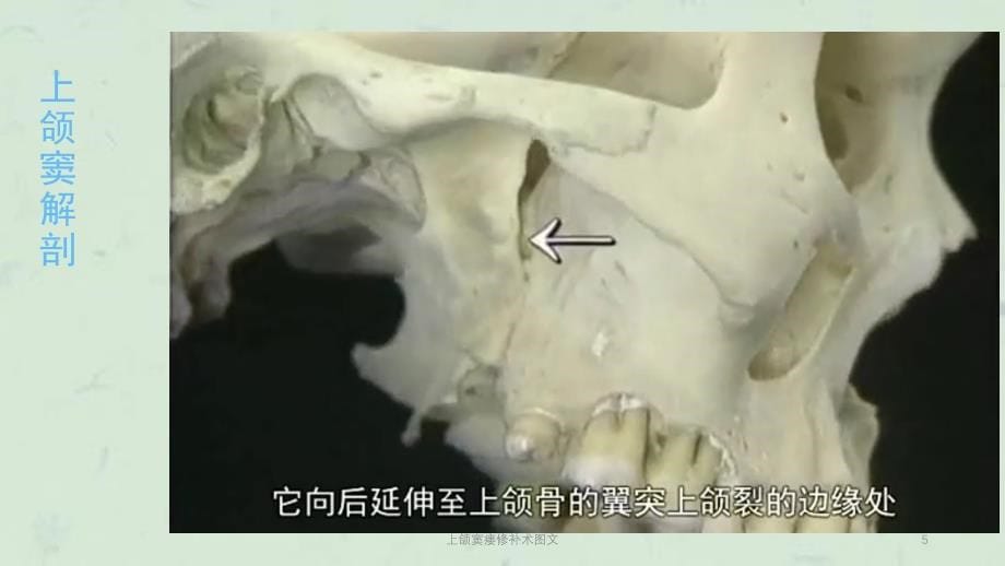 上颌窦瘘修补术图文课件_第5页