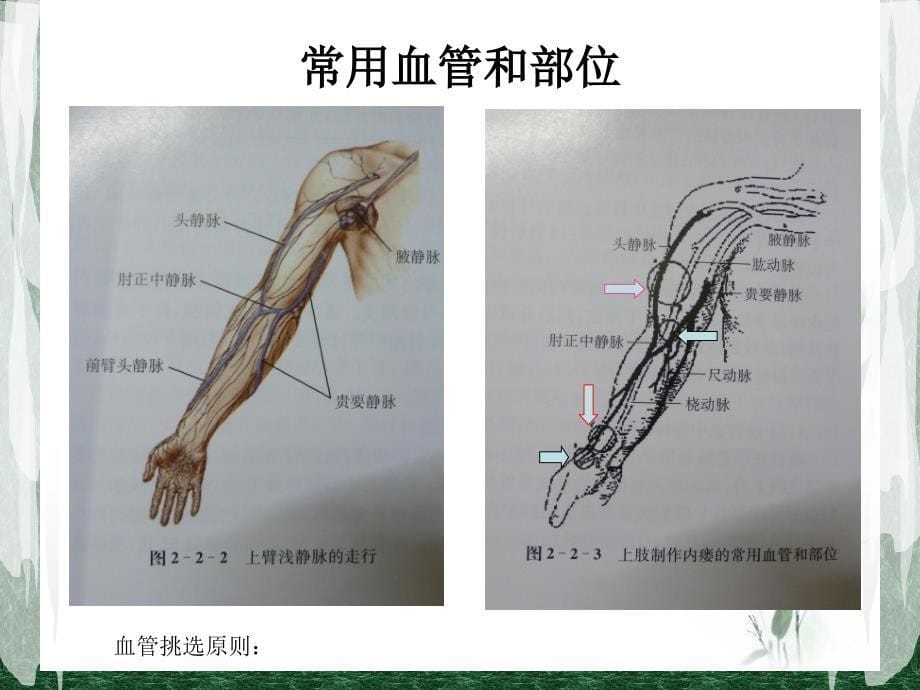 动静脉内瘘_第5页