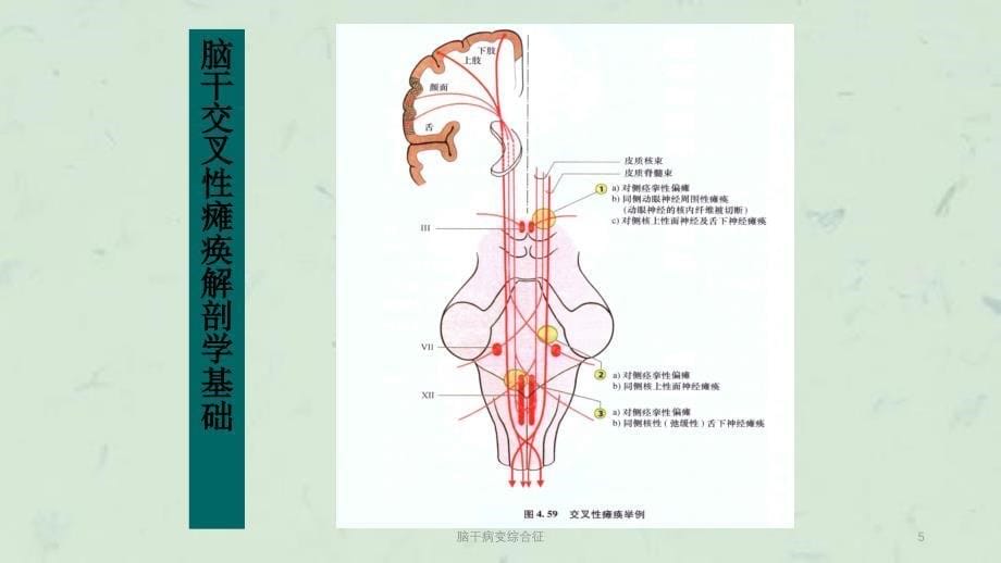 脑干病变综合征课件_第5页