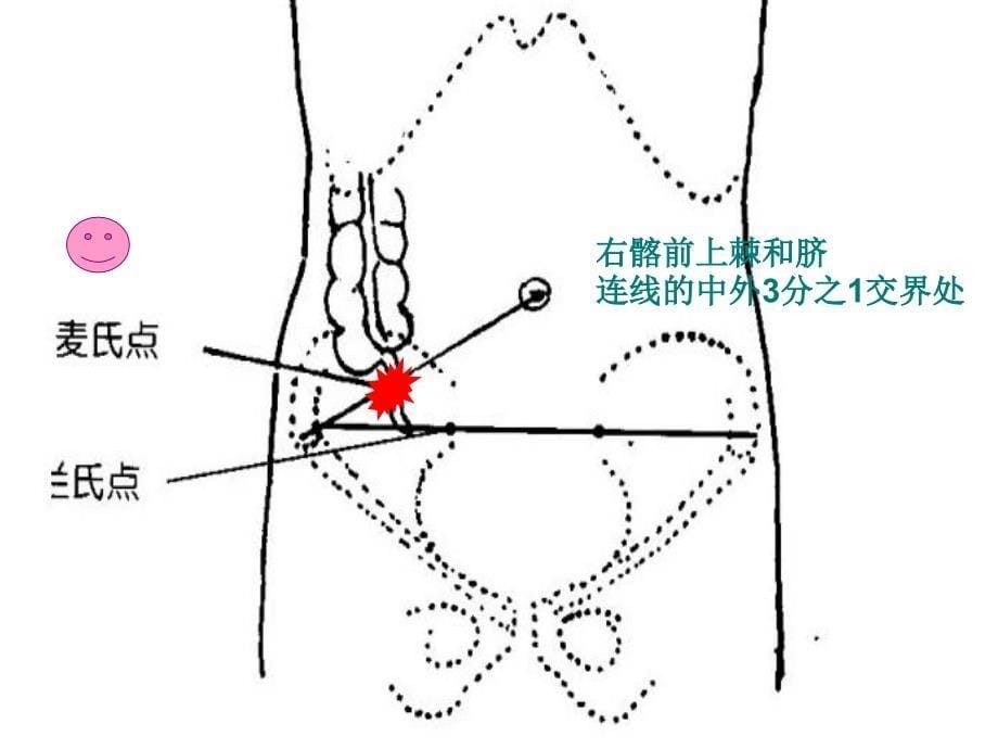 阑尾炎业务学习_第5页