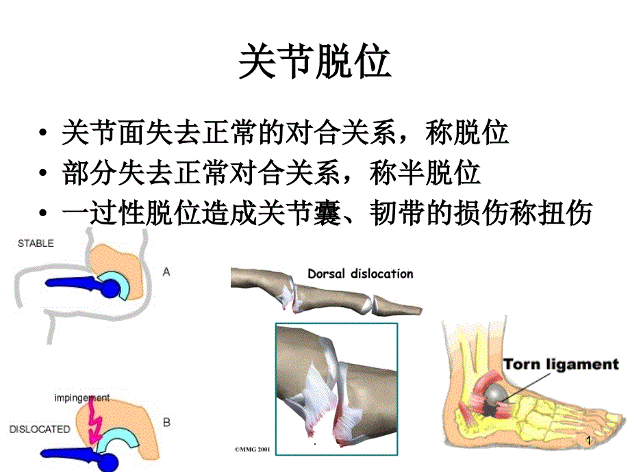 (医学课件)关节脱位ppt演示课件_第1页