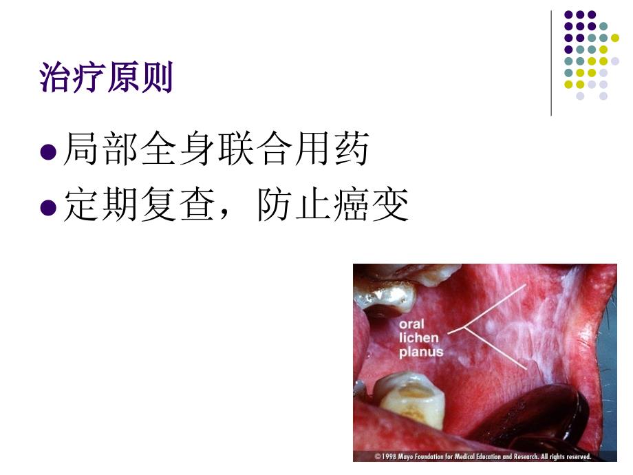 口腔扁平苔藓的治疗及预后_第2页