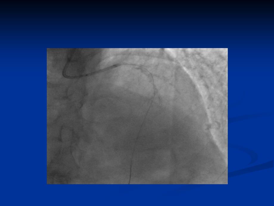 冠脉造影的判读PPT课件_第4页