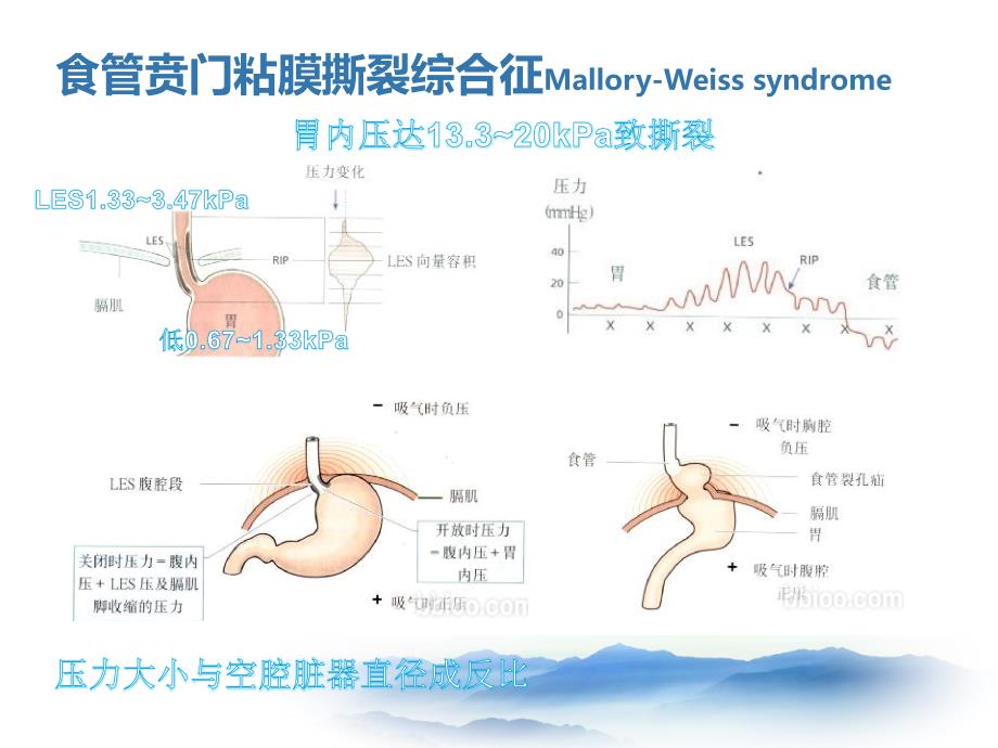 上消化道出血少见病因lcc课件_第3页