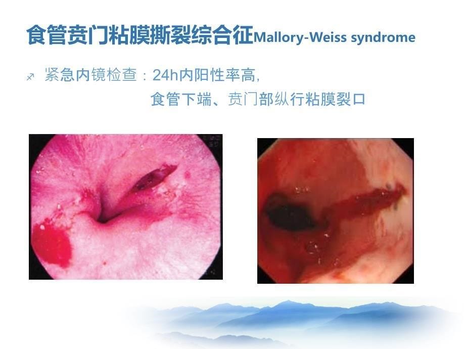 上消化道出血少见病因lcc课件_第5页