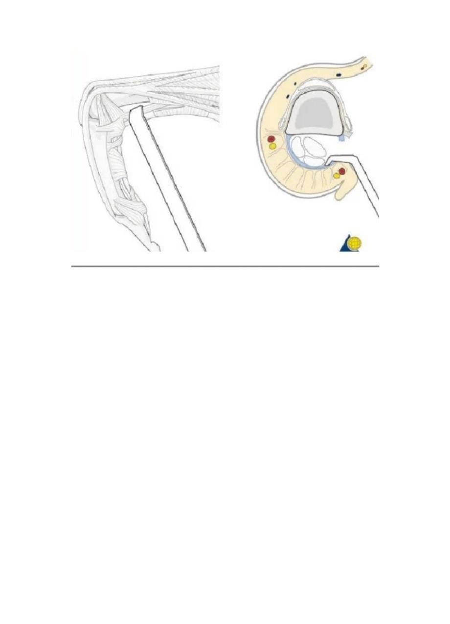 手指骨折侧方入路的手术技巧_第5页