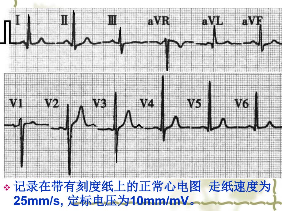 正常心电图及常见异常心电图ppt课件_第3页