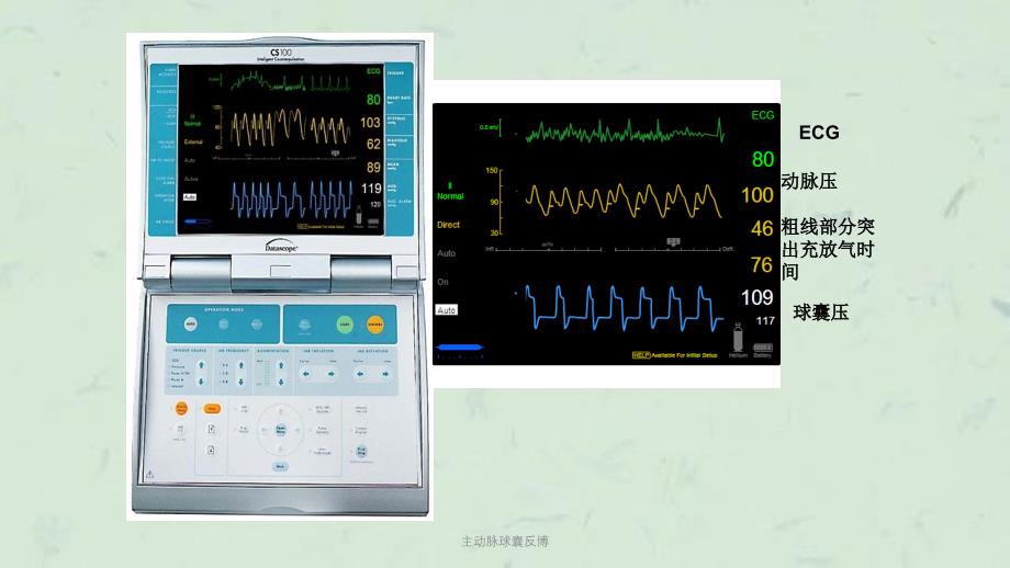 主动脉球囊反博课件_第2页