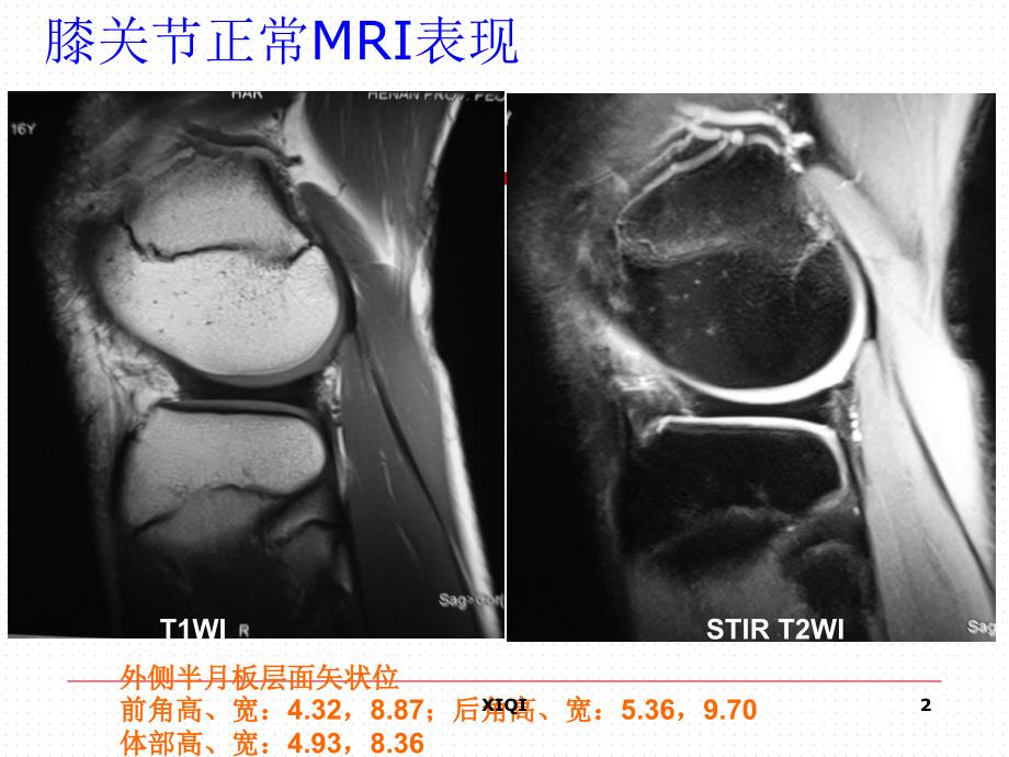 膝关节正常MRI表现及损伤诊断_第2页