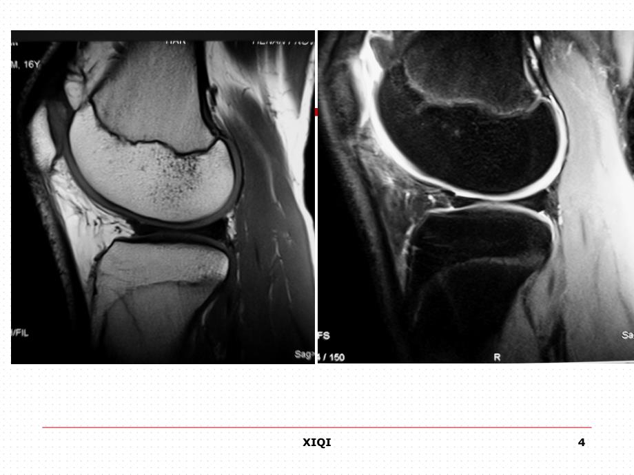 膝关节正常MRI表现及损伤诊断_第4页