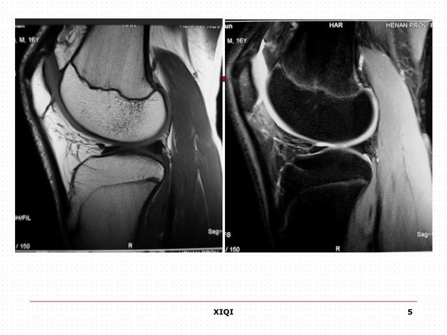 膝关节正常MRI表现及损伤诊断_第5页