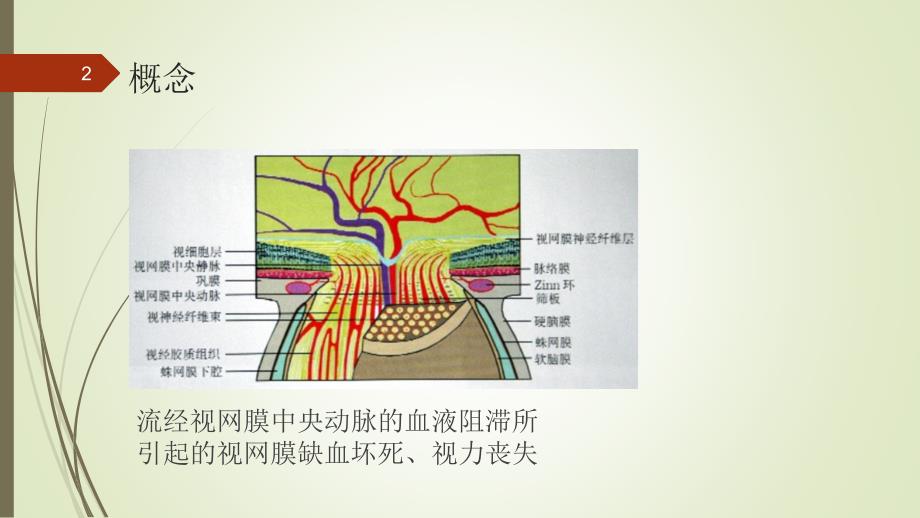 视网膜中央动脉阻塞优秀课件_第2页