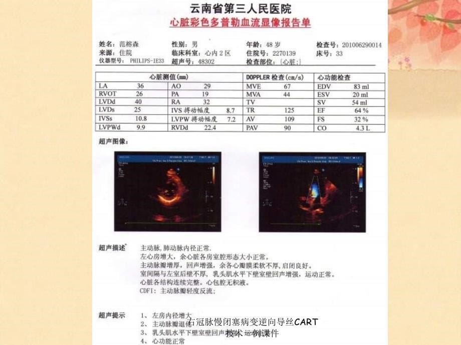 右冠脉慢闭塞病变逆向导丝CART技术一例课件_第5页