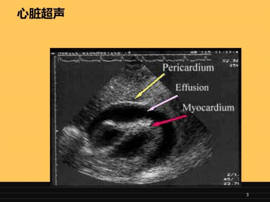 心包穿刺术图文1672960837.ppt_第3页