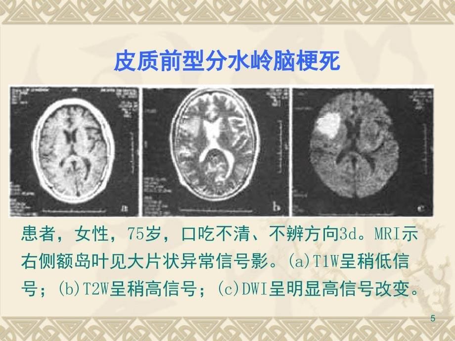 分水岭梗死CWI分享课件_第5页