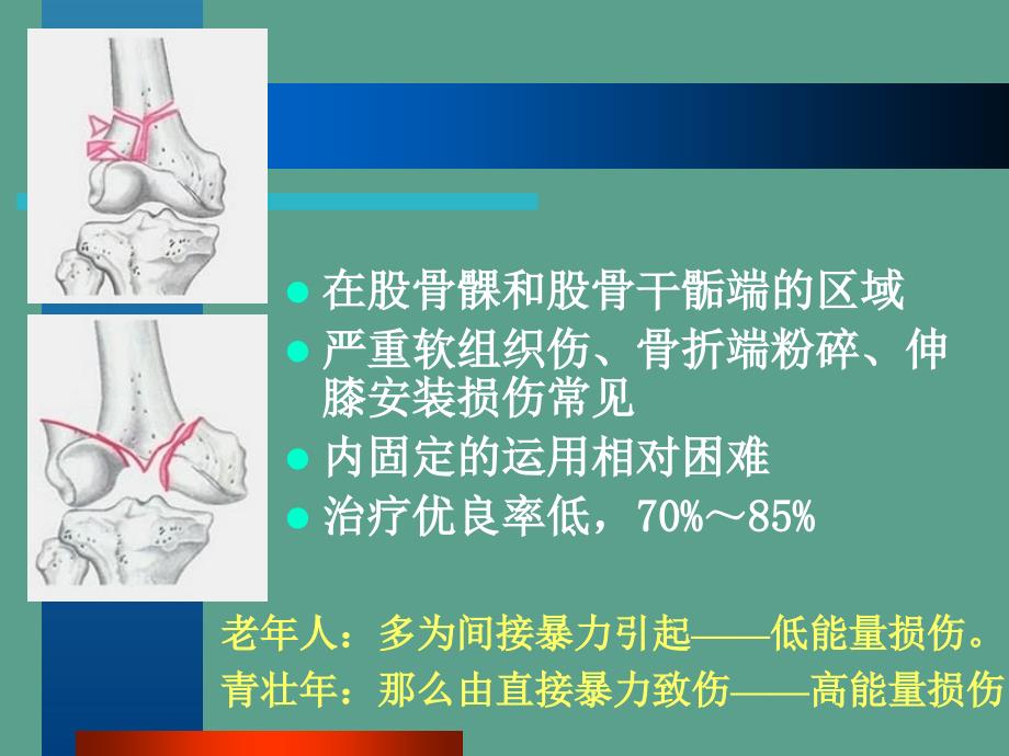 股骨远端骨折微创治疗周荣兴ppt课件_第2页