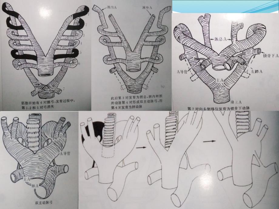 主动脉弓及其主支的先天畸形_第2页