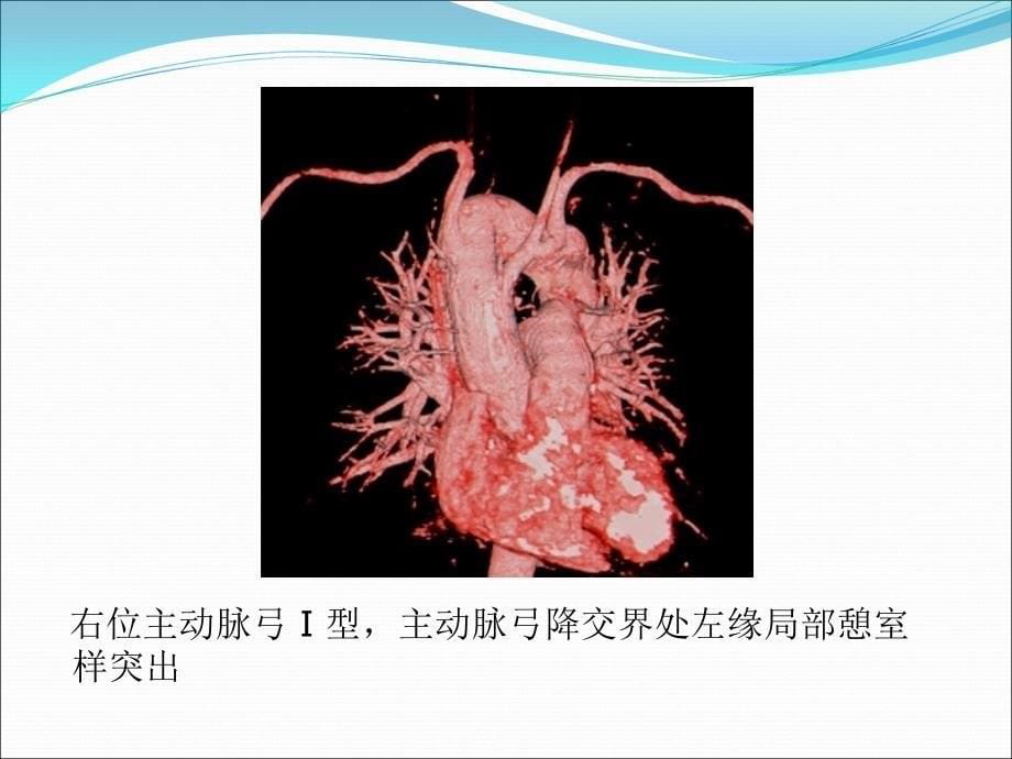 主动脉弓及其主支的先天畸形_第5页