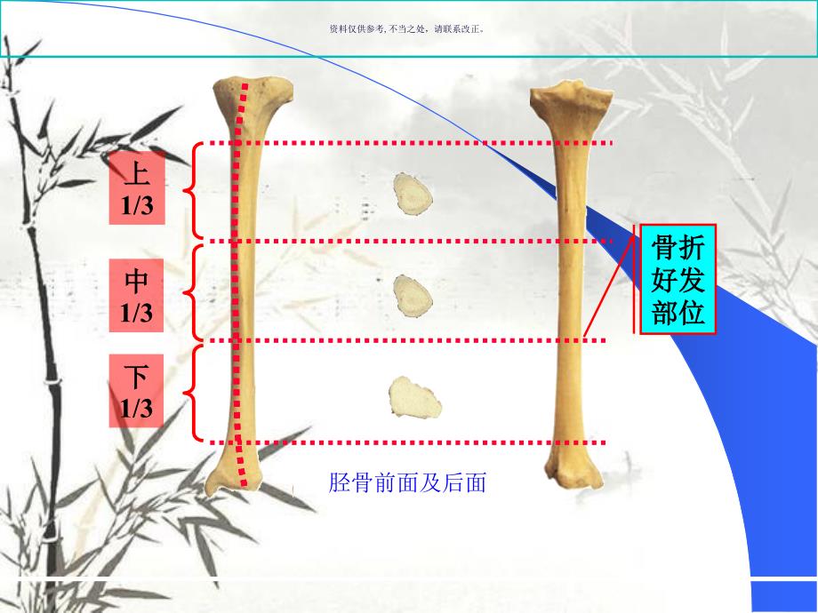 胫腓骨干骨折课件_第4页