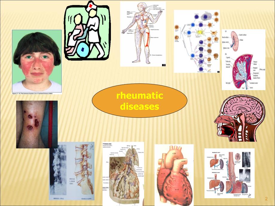 风湿性疾病的实验诊断ppt课件_第2页