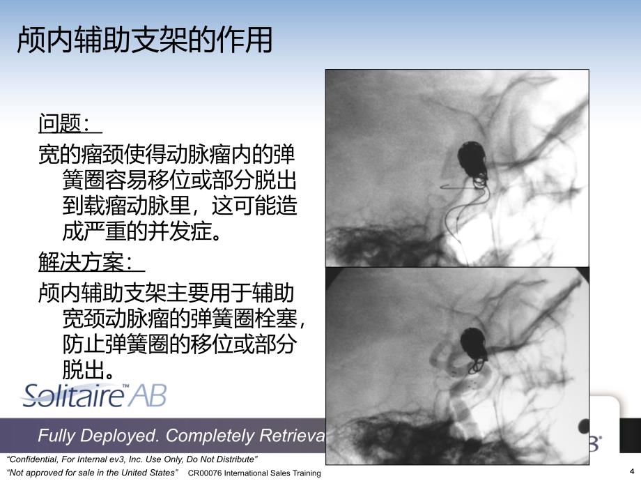 SOLITAIRE颅内支架[行业特制]_第4页