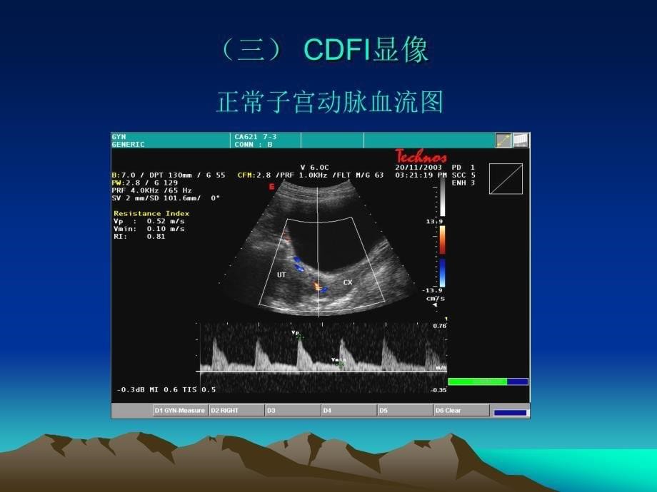 彩超在妇科方面的运用课件_第5页