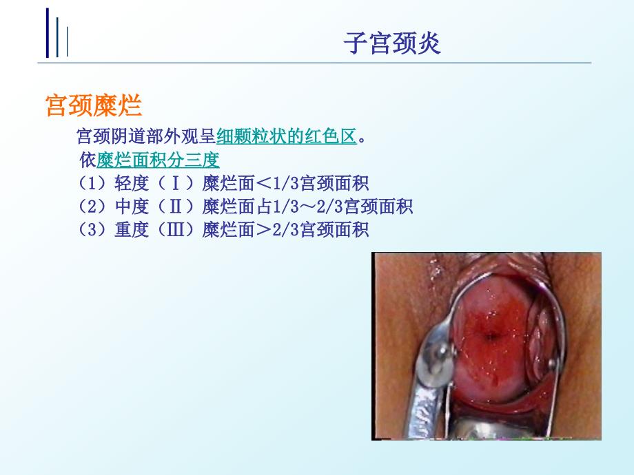 子宫颈炎_第3页