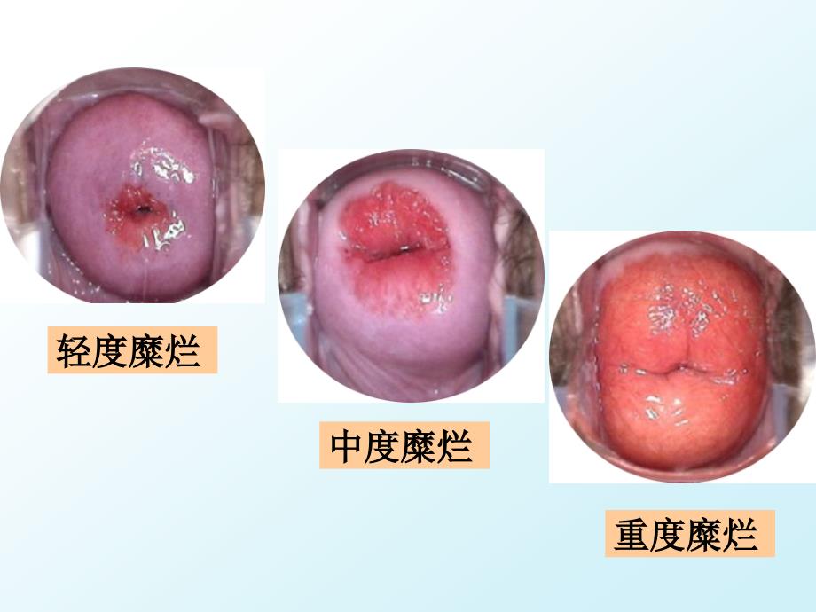 子宫颈炎_第4页