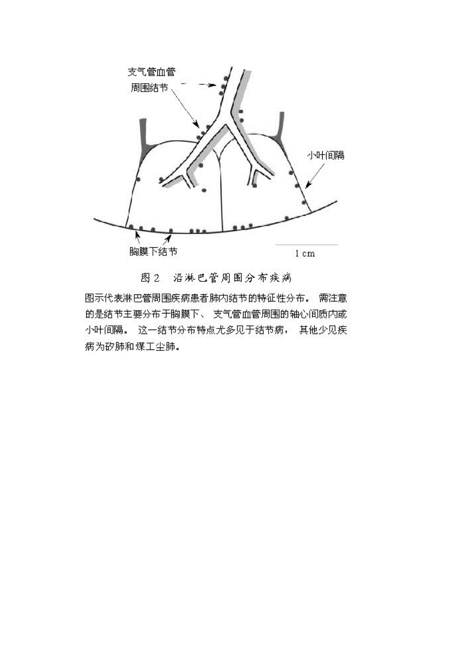 肺内多发结节的高分辨率CT鉴别诊断流程 (2).doc_第4页